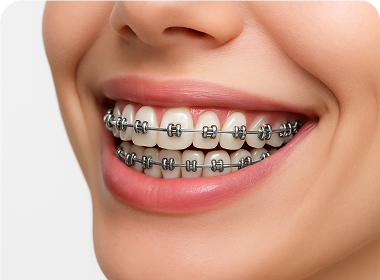 Klassische Brackets